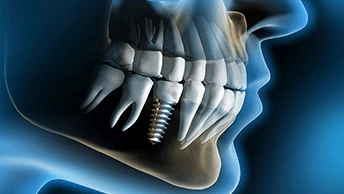 All-On-4 Dental Implants Cost From $12,000 To $25,000 Per Arch